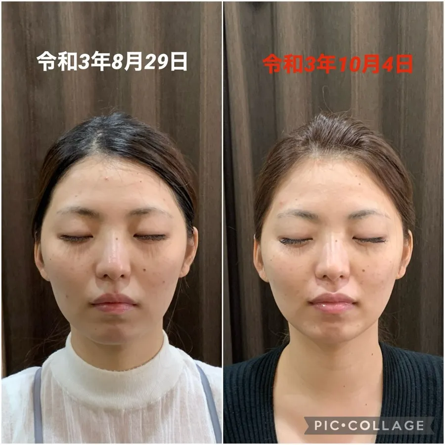 美極鍼の症例画像