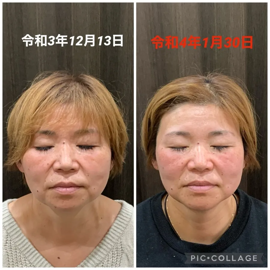 美極鍼αの症例画像