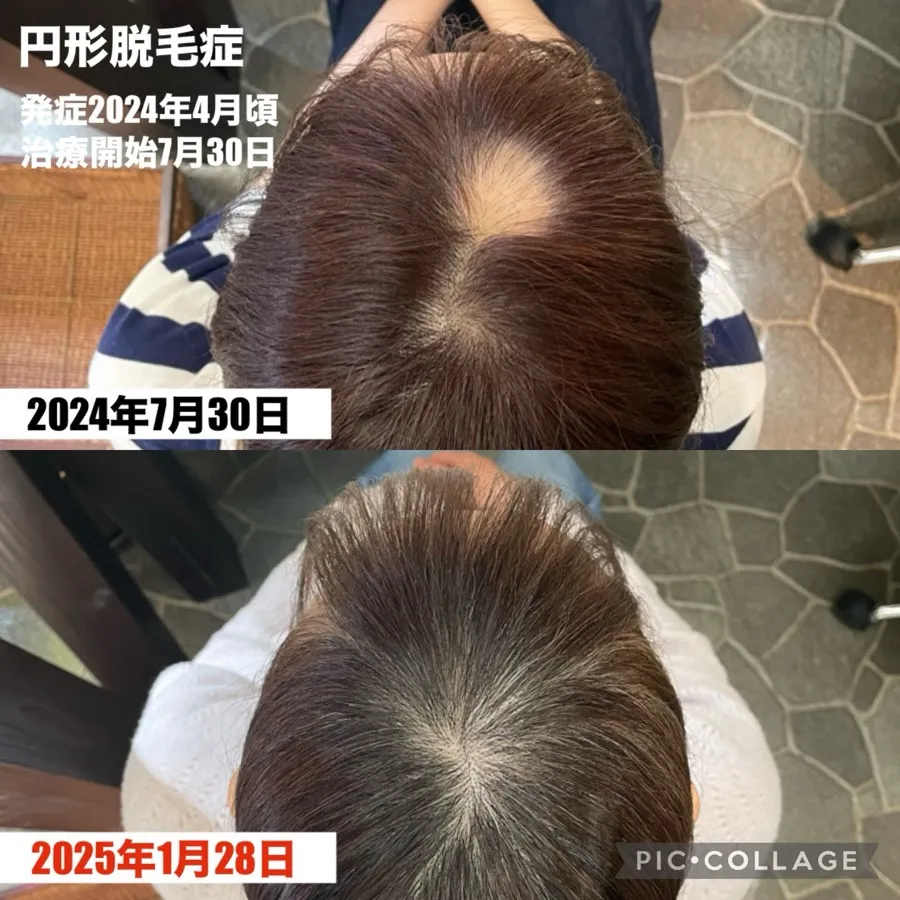円形脱毛症の症例画像1