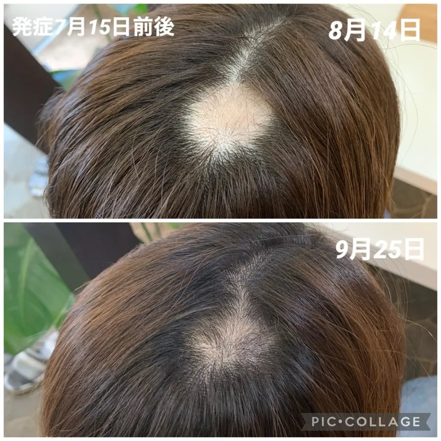 円形脱毛症の症例画像3