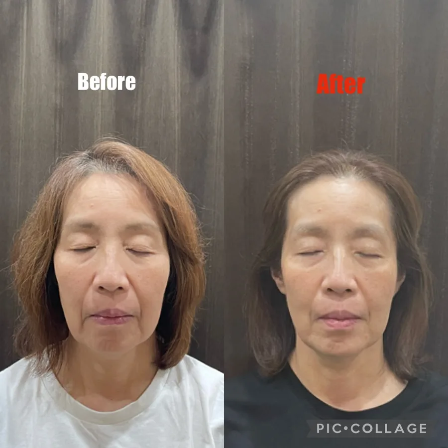 女優鍼の症例画像