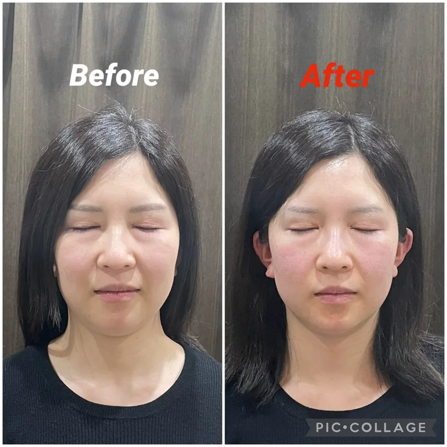 女優鍼αの症例画像1