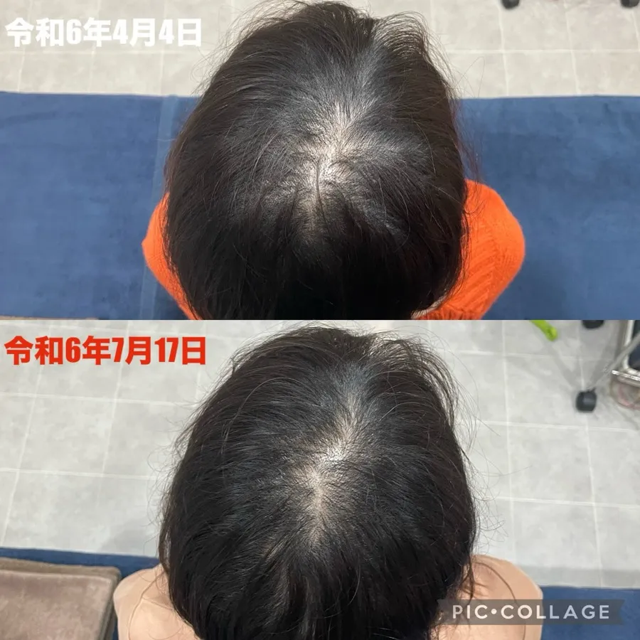 薄毛治療の症例画像1