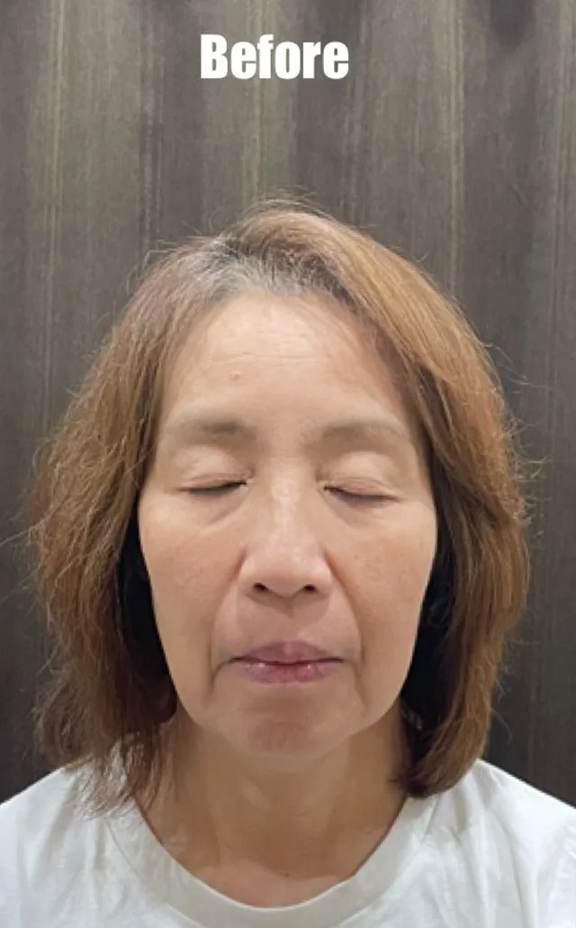 しわ、たるみ 施術前