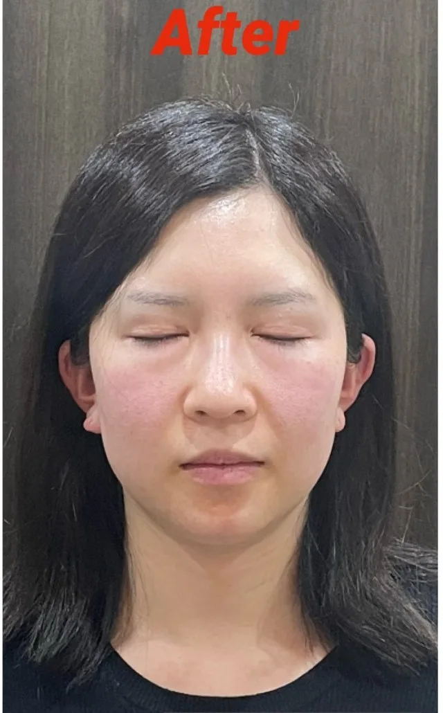 むくみ、小顔 施術後