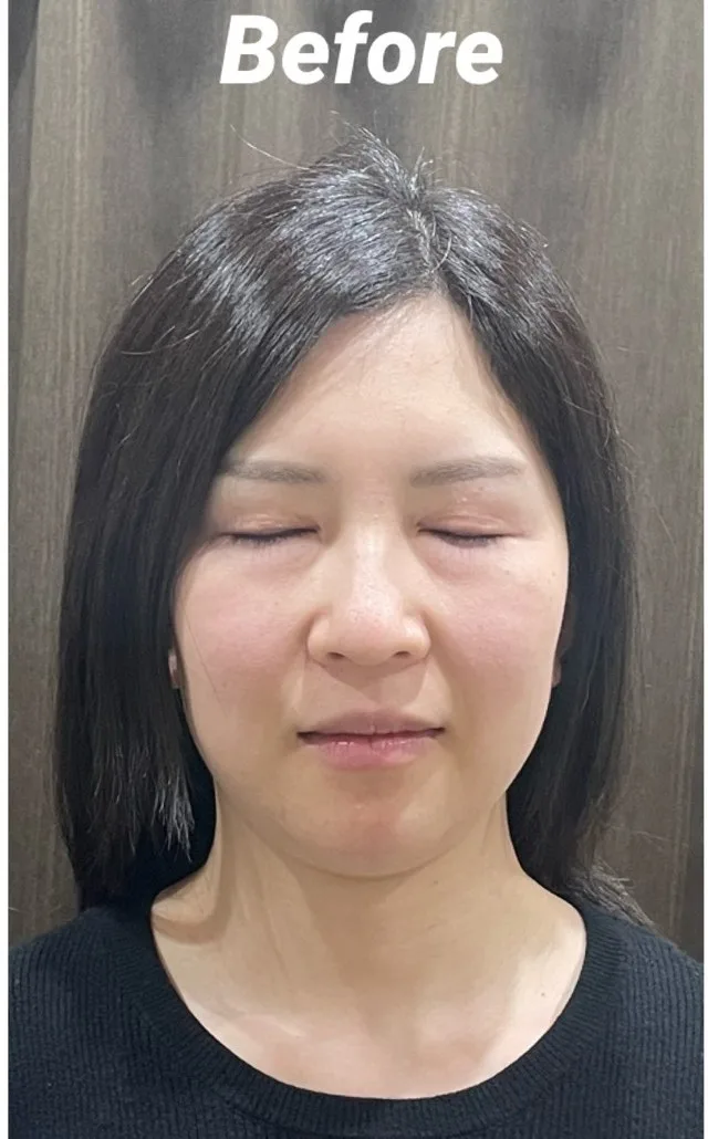 むくみ、小顔 施術前