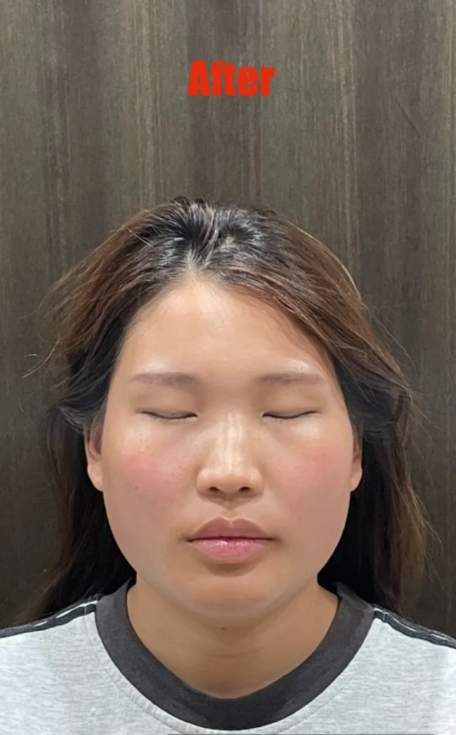 むくみ、小顔 施術後