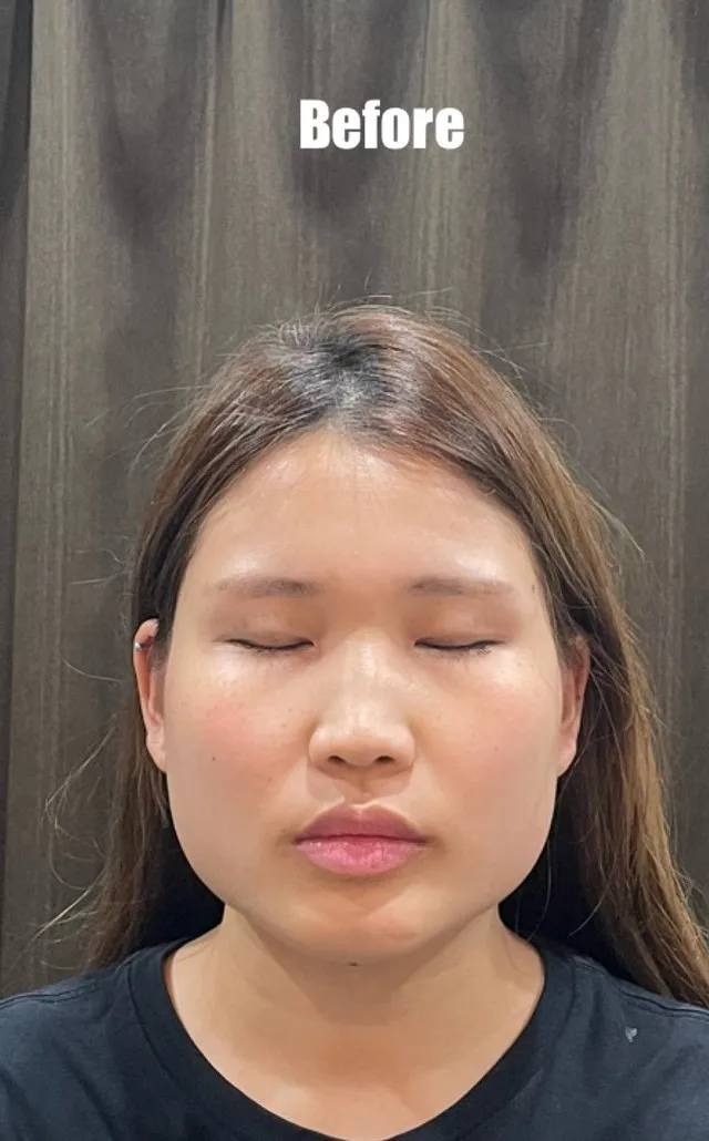 むくみ、小顔 施術前